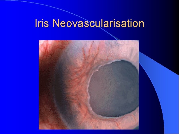 Iris Neovascularisation 