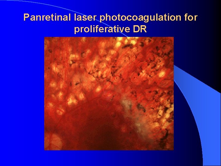 Panretinal laser photocoagulation for proliferative DR 