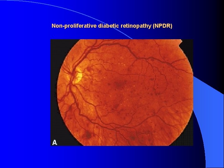 Non-proliferative diabetic retinopathy (NPDR) 