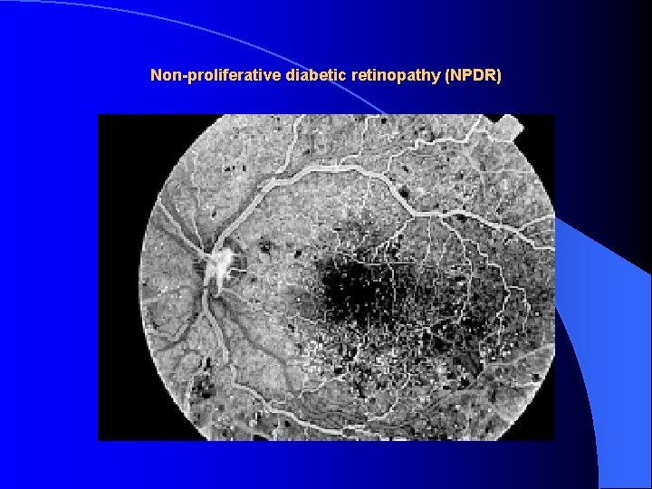 Non-proliferative diabetic retinopathy (NPDR) 