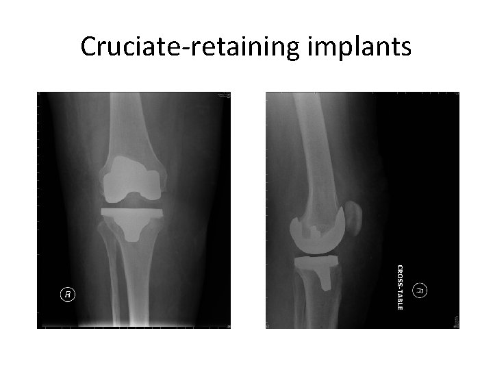 Cruciate-retaining implants 