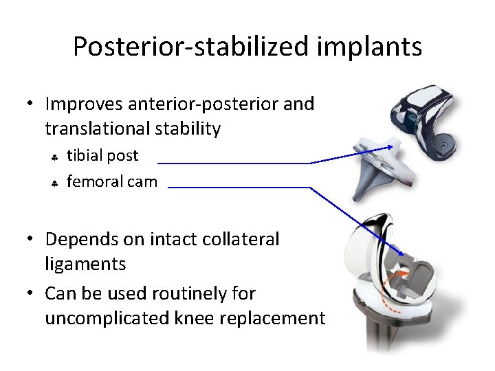 Posterior-stabilized implants • Improves anterior-posterior and translational stability § § tibial post femoral cam