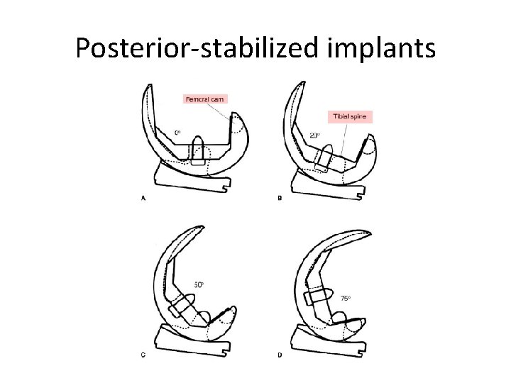 Posterior-stabilized implants 