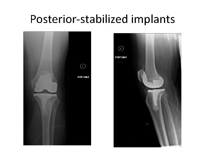 Posterior-stabilized implants 