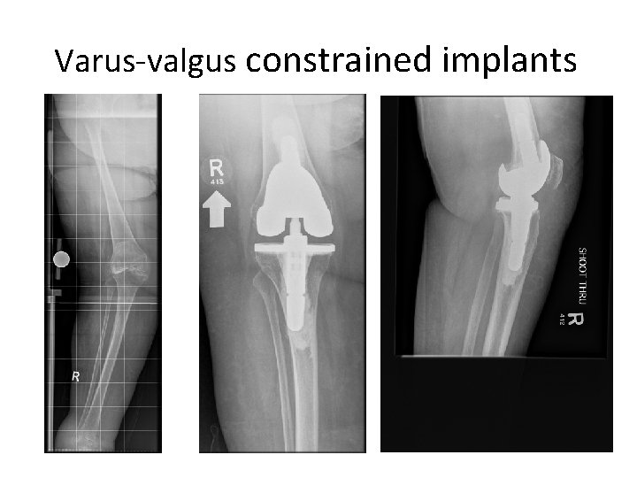 Varus-valgus constrained implants 