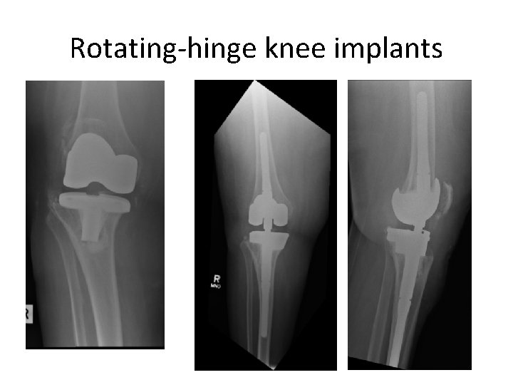 Rotating-hinge knee implants 