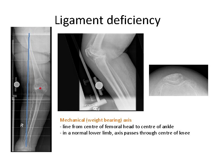 Ligament deficiency Mechanical (weight bearing) axis - line from centre of femoral head to