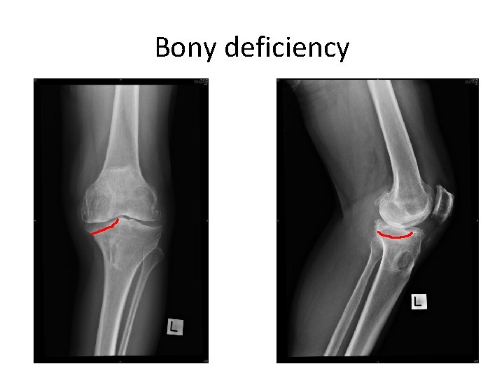 Bony deficiency 