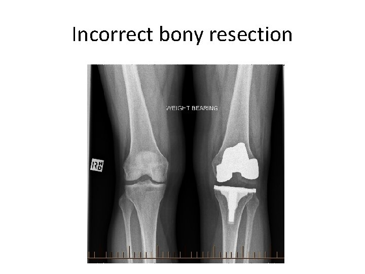 Incorrect bony resection 