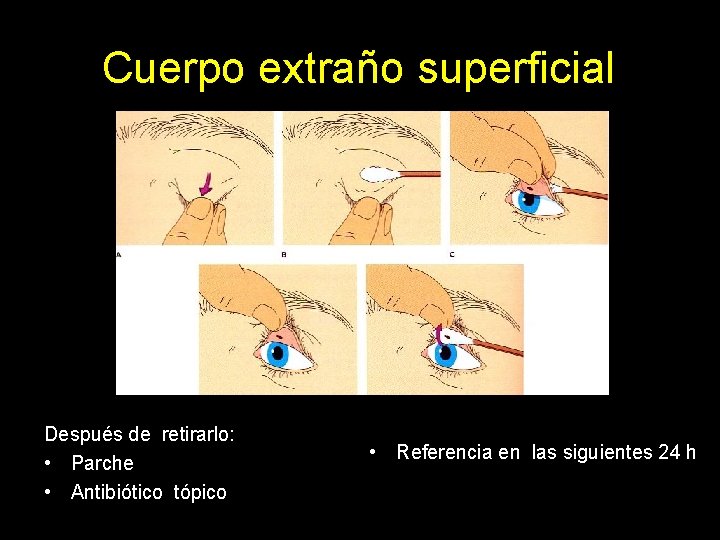 Cuerpo extraño superficial Después de retirarlo: • Parche • Antibiótico tópico • Referencia en