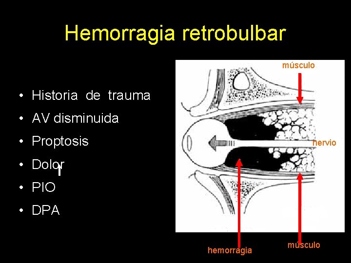 Hemorragia retrobulbar músculo • Historia de trauma • AV disminuida • Proptosis nervio •