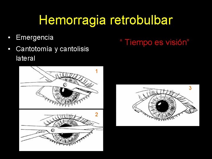 Hemorragia retrobulbar • Emergencia “ Tiempo es visión” • Cantotomía y cantolisis lateral 1