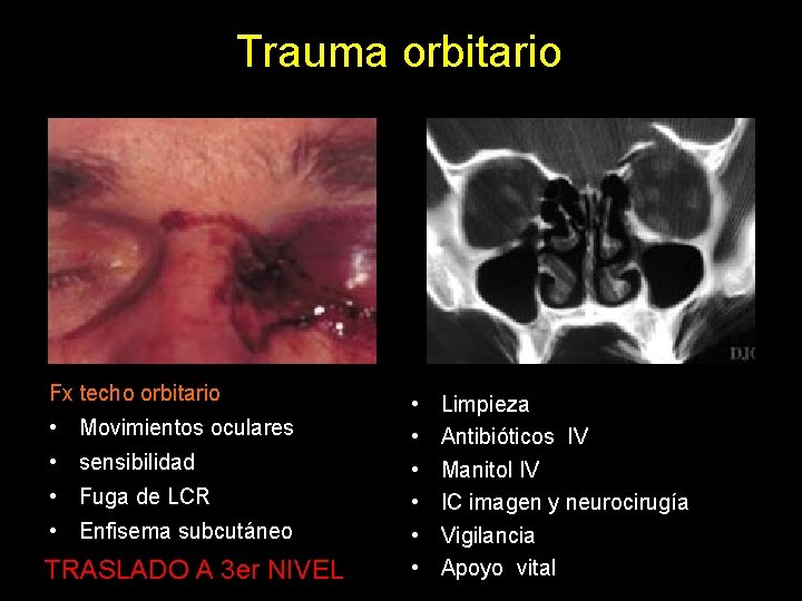 Trauma orbitario Fx techo orbitario • Movimientos oculares • sensibilidad • Fuga de LCR