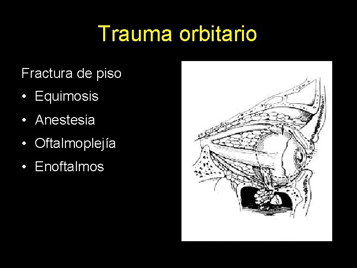 Trauma orbitario Fractura de piso • Equimosis • Anestesia • Oftalmoplejía • Enoftalmos 