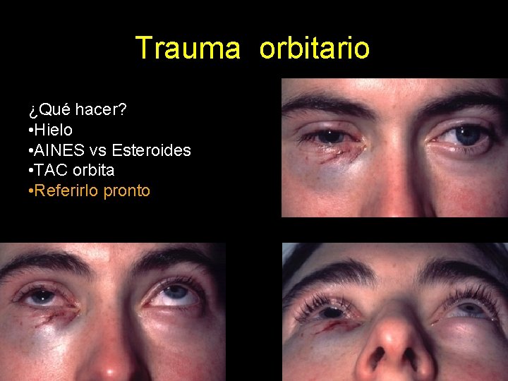 Trauma orbitario ¿Qué hacer? • Hielo • AINES vs Esteroides • TAC orbita •