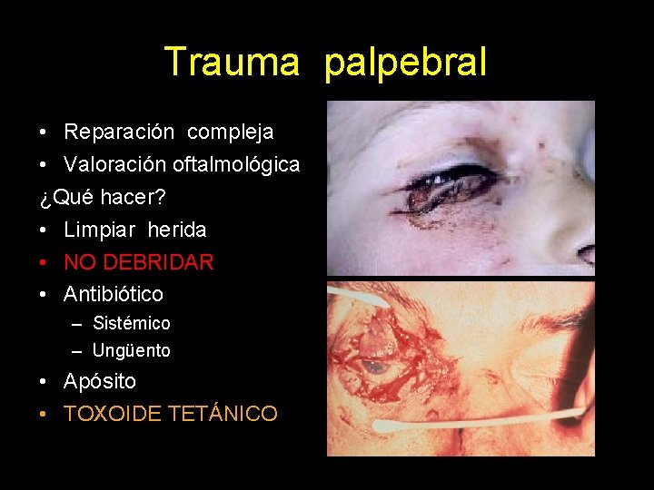 Trauma palpebral • Reparación compleja • Valoración oftalmológica ¿Qué hacer? • Limpiar herida •