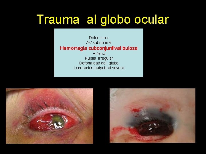 Trauma al globo ocular Dolor ++++ AV subnormal Hemorragia subconjuntival bulosa Hifema Pupila irregular