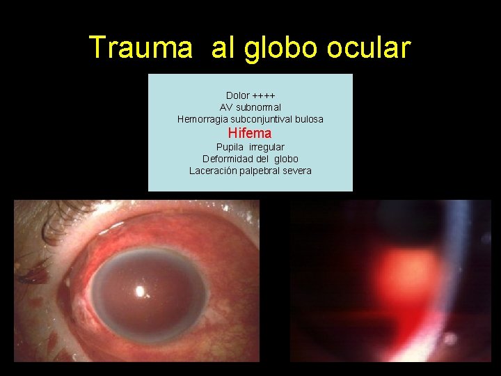 Trauma al globo ocular Dolor ++++ AV subnormal Hemorragia subconjuntival bulosa Hifema Pupila irregular