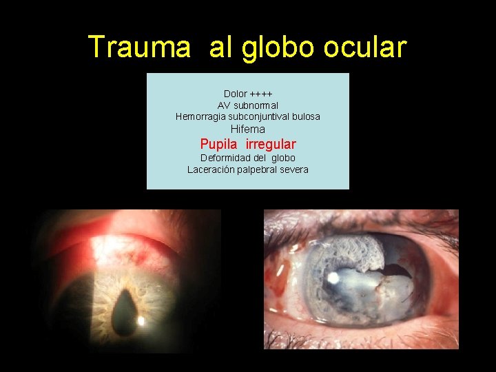 Trauma al globo ocular Dolor ++++ AV subnormal Hemorragia subconjuntival bulosa Hifema Pupila irregular