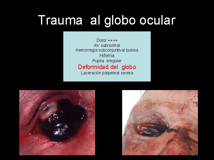 Trauma al globo ocular Dolor ++++ AV subnormal Hemorragia subconjuntival bulosa Hifema Pupila irregular