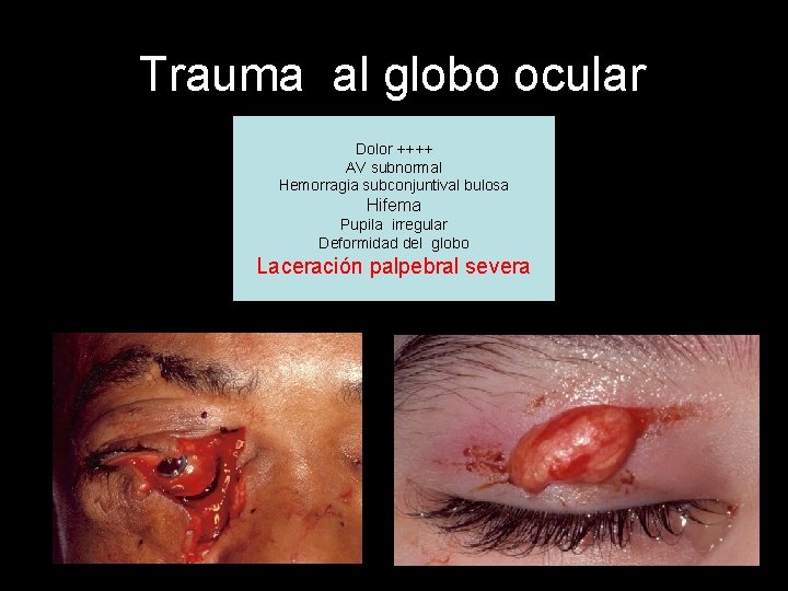 Trauma al globo ocular Dolor ++++ AV subnormal Hemorragia subconjuntival bulosa Hifema Pupila irregular