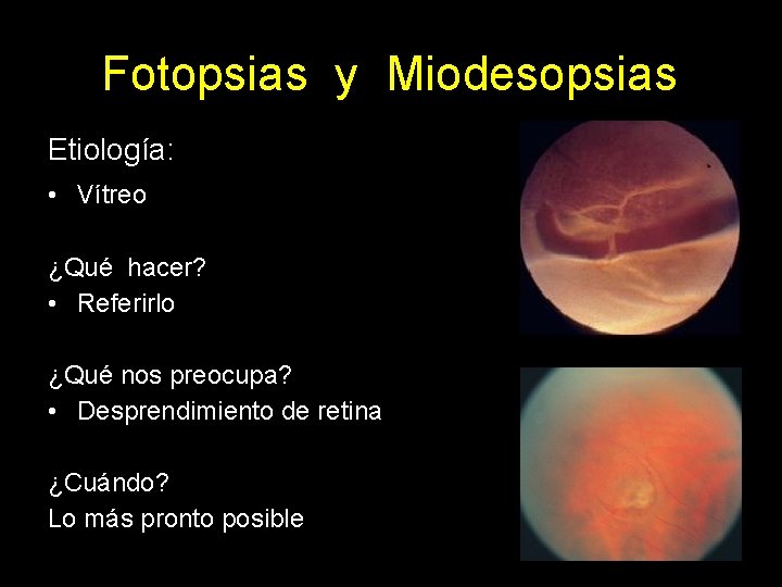 Fotopsias y Miodesopsias Etiología: • Vítreo ¿Qué hacer? • Referirlo ¿Qué nos preocupa? •