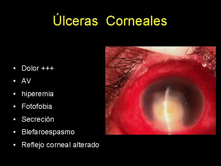 Úlceras Corneales • Dolor +++ • AV • hiperemia • Fotofobia • Secreción •