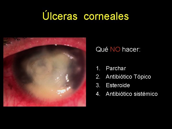 Úlceras corneales Qué NO hacer: 1. 2. 3. 4. Parchar Antibiótico Tópico Esteroide Antibiótico