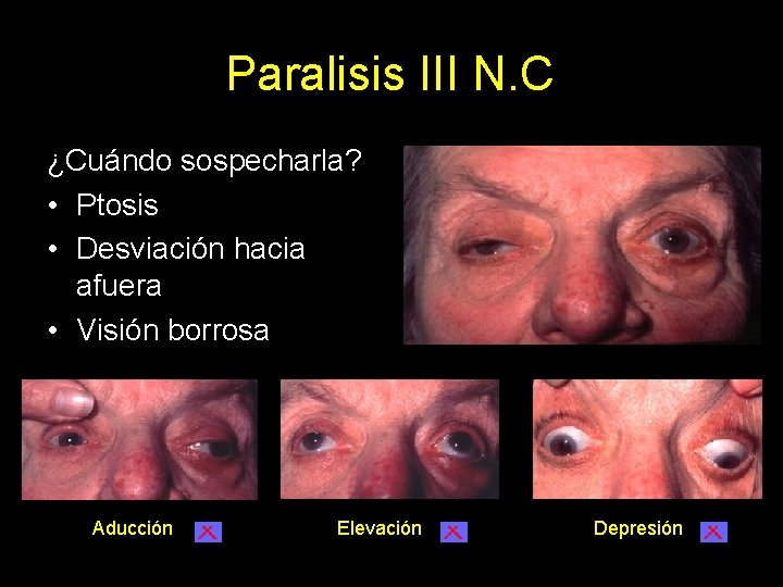 Paralisis III N. C ¿Cuándo sospecharla? • Ptosis • Desviación hacia afuera • Visión