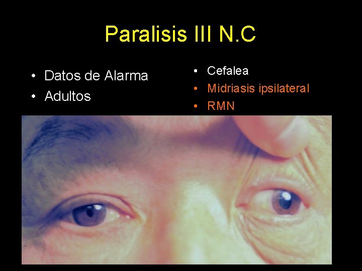 Paralisis III N. C • Datos de Alarma • Adultos • Cefalea • Midriasis