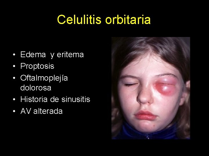 Celulitis orbitaria • Edema y eritema • Proptosis • Oftalmoplejía dolorosa • Historia de