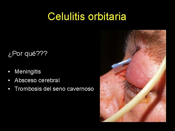 Celulitis orbitaria ¿Por qué? ? ? • Meningitis • Absceso cerebral • Trombosis del