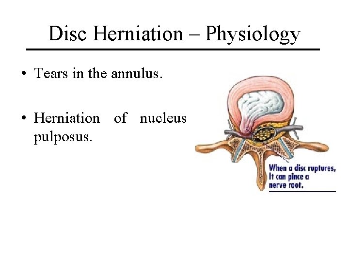 Disc Herniation – Physiology • Tears in the annulus. • Herniation of nucleus pulposus.