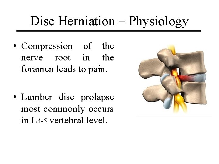 Disc Herniation – Physiology • Compression of the nerve root in the foramen leads