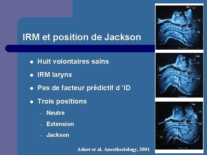 IRM et position de Jackson l Huit volontaires sains l IRM larynx l Pas