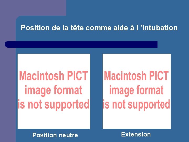 Position de la tête comme aide à l ’intubation Position neutre Extension 