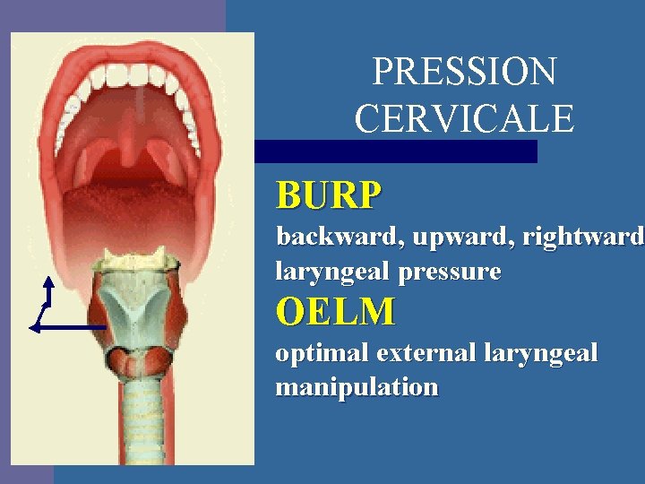 PRESSION CERVICALE BURP backward, upward, rightward laryngeal pressure OELM optimal external laryngeal manipulation 