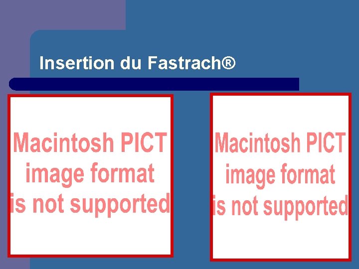 Insertion du Fastrach® 