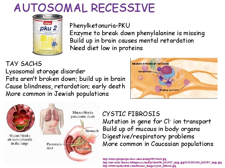 AUTOSOMAL RECESSIVE Phenylketonuria-PKU Enzyme to break down phenylalanine is missing Build up in brain