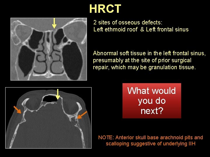 HRCT 2 sites of osseous defects: Left ethmoid roof & Left frontal sinus Abnormal