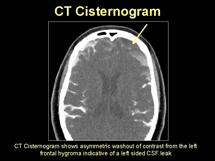 CT Cisternogram shows asymmetric washout of contrast from the left frontal hygroma indicative of