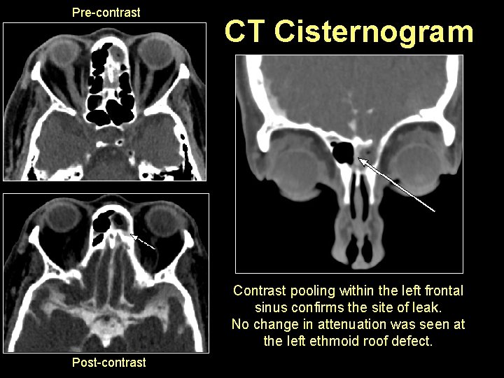 Pre-contrast CT Cisternogram Contrast pooling within the left frontal sinus confirms the site of