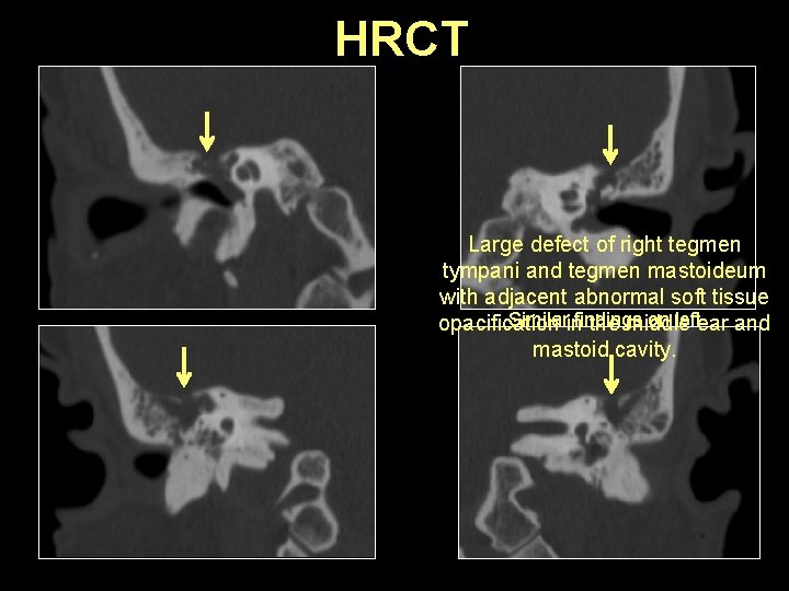 HRCT Large defect of right tegmen tympani and tegmen mastoideum with adjacent abnormal soft