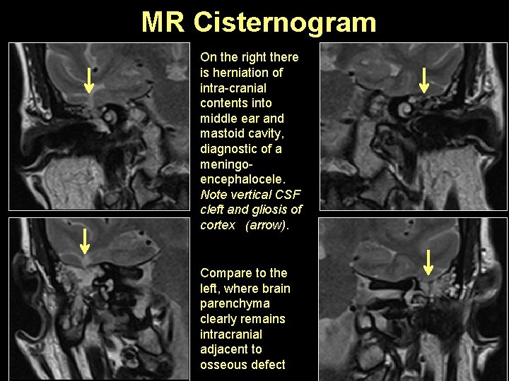 MR Cisternogram On the right there is herniation of intra-cranial contents into middle ear