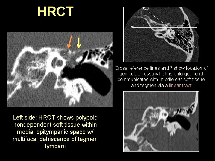 HRCT * Cross reference lines and * show location of geniculate fossa which is