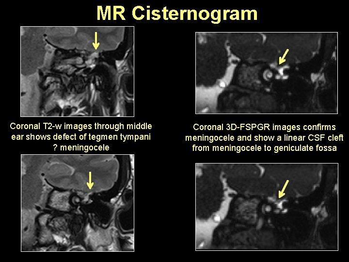 MR Cisternogram Coronal T 2 -w images through middle ear shows defect of tegmen