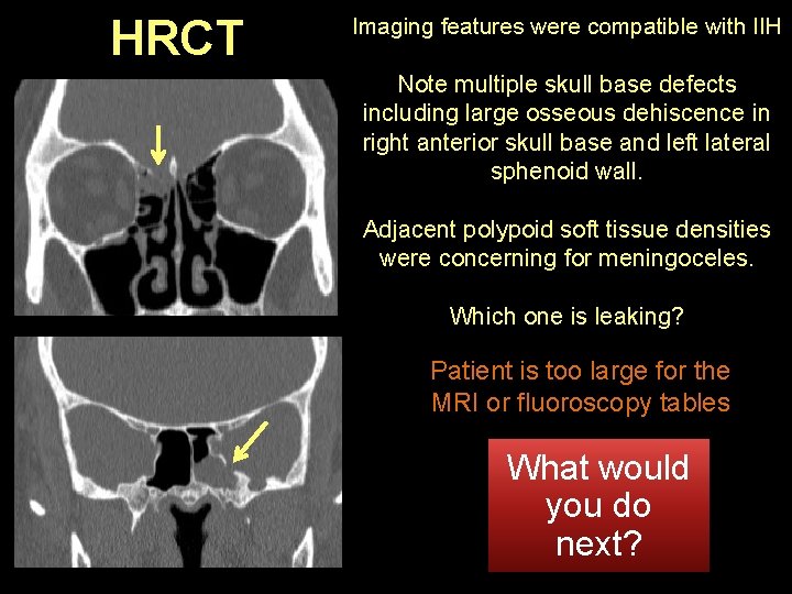 HRCT Imaging features were compatible with IIH Note multiple skull base defects including large