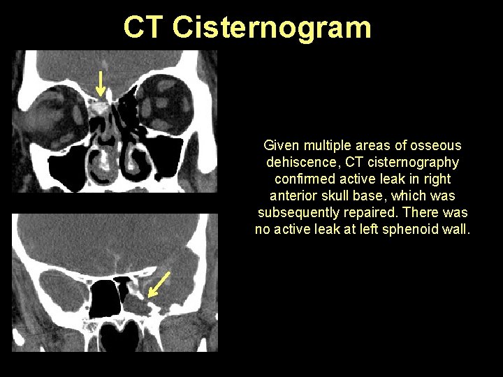 CT Cisternogram Given multiple areas of osseous dehiscence, CT cisternography confirmed active leak in