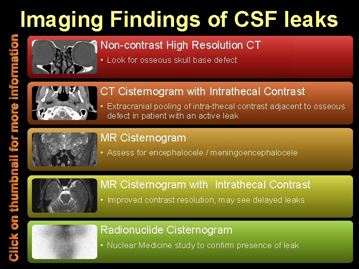 Imaging Findings of CSF leaks Non-contrast High Resolution CT • Look for osseous skull
