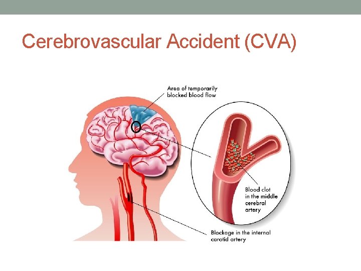 Cerebrovascular Accident (CVA) 